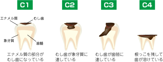 しみたり、痛みを感じたらもう手遅れ