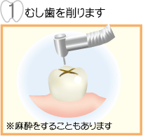 むし歯を削ります