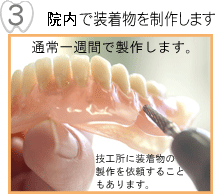技工所で装着物を製作します