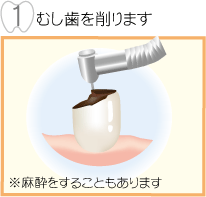 むし歯を削ります