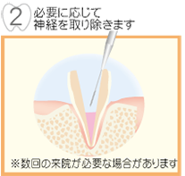 必要に応じて神経を取り除きます