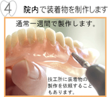 技工所で装着物を製作します