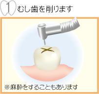 むし歯を削ります