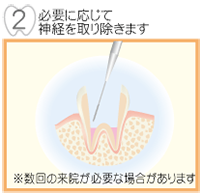 必要に応じて神経を取り除きます