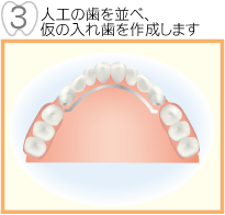人工の歯を並べ仮の入れ歯を作成します