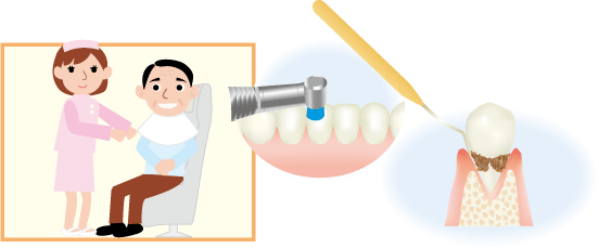 歯周病の治療法は？